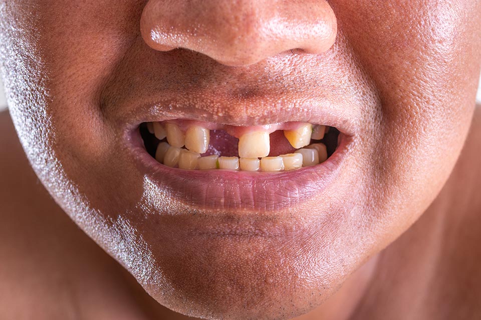 Tooth Loss