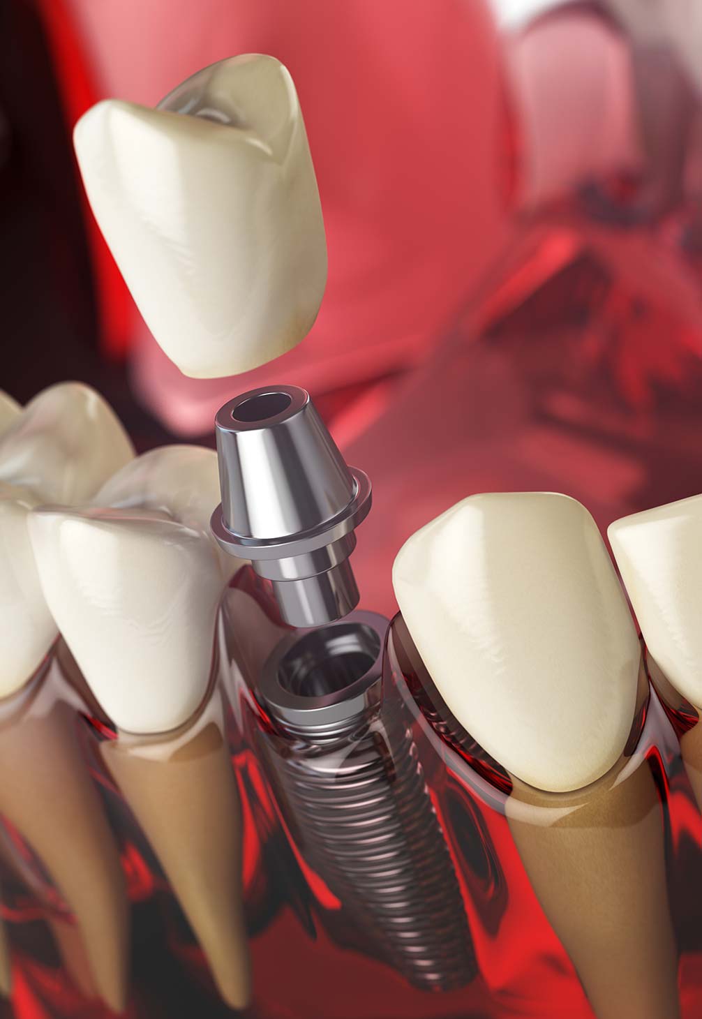 All-on-4 Dental Implants